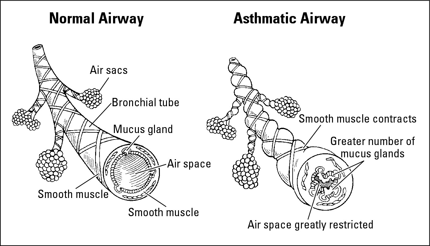 Figure 2-1: A normal airway and an asthmatic airway. Note the muscle contractions (broncho-spasms) and airway inflam-mation.